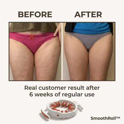 SmoothRoll™ - 360 Degree Cellulite Reducer