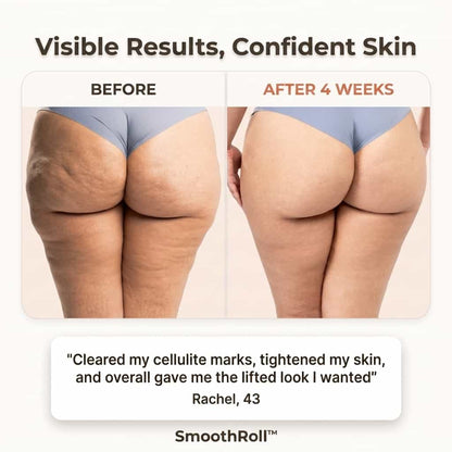 SmoothRoll™ - 360 Degree Cellulite Reducer