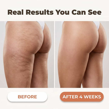SmoothRoll™ - 360 Degree Cellulite Reducer